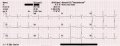 Ukázka záznamu dvanáctisvodového EKG - trojice svodů následujíc v čase za sebou<br />
